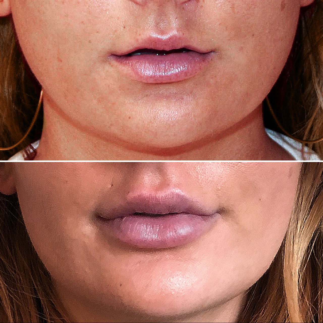 lip fillers treatment results