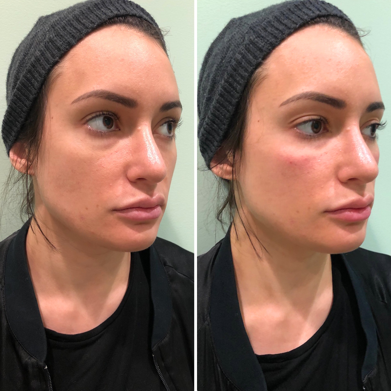 Photo of before and after results of facial fillers for women.