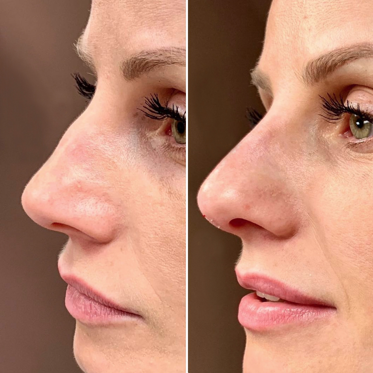 Non Surgical Nose Job In NYC Rhinoplasty For Men And Women In 