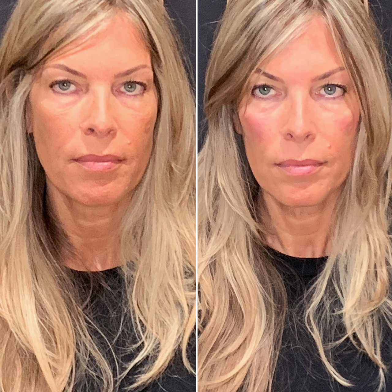 Before and after image of skin rejuvenation.