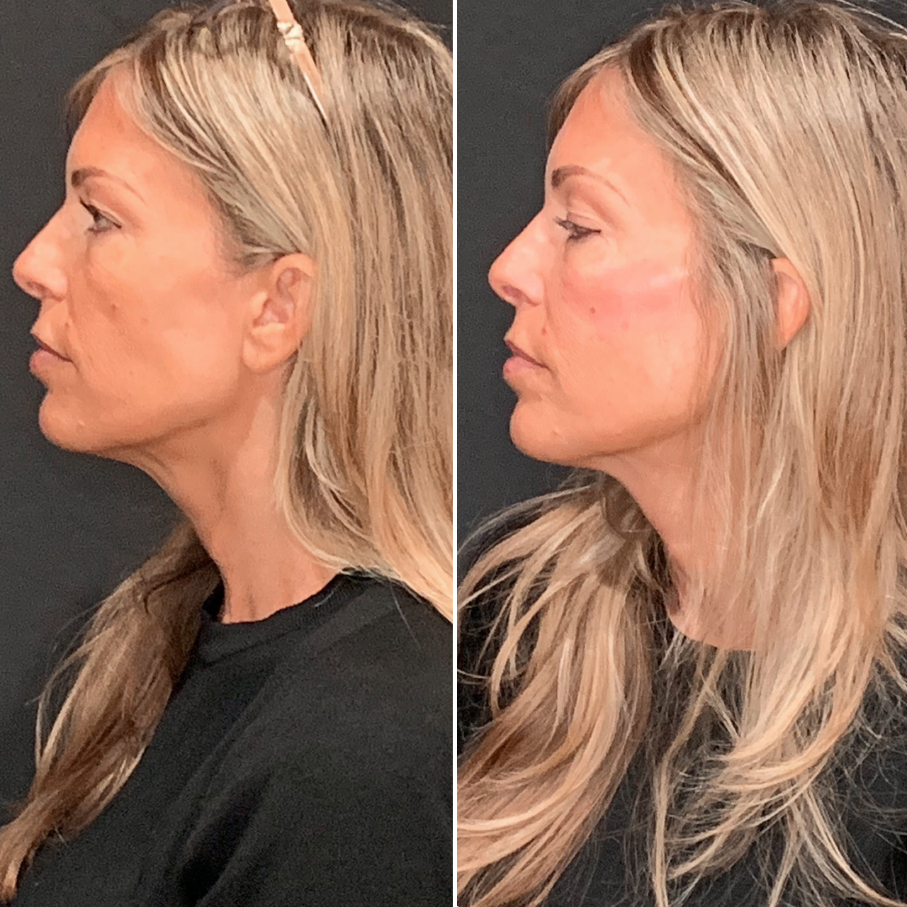 Skin Rejuvenation Results Image 2