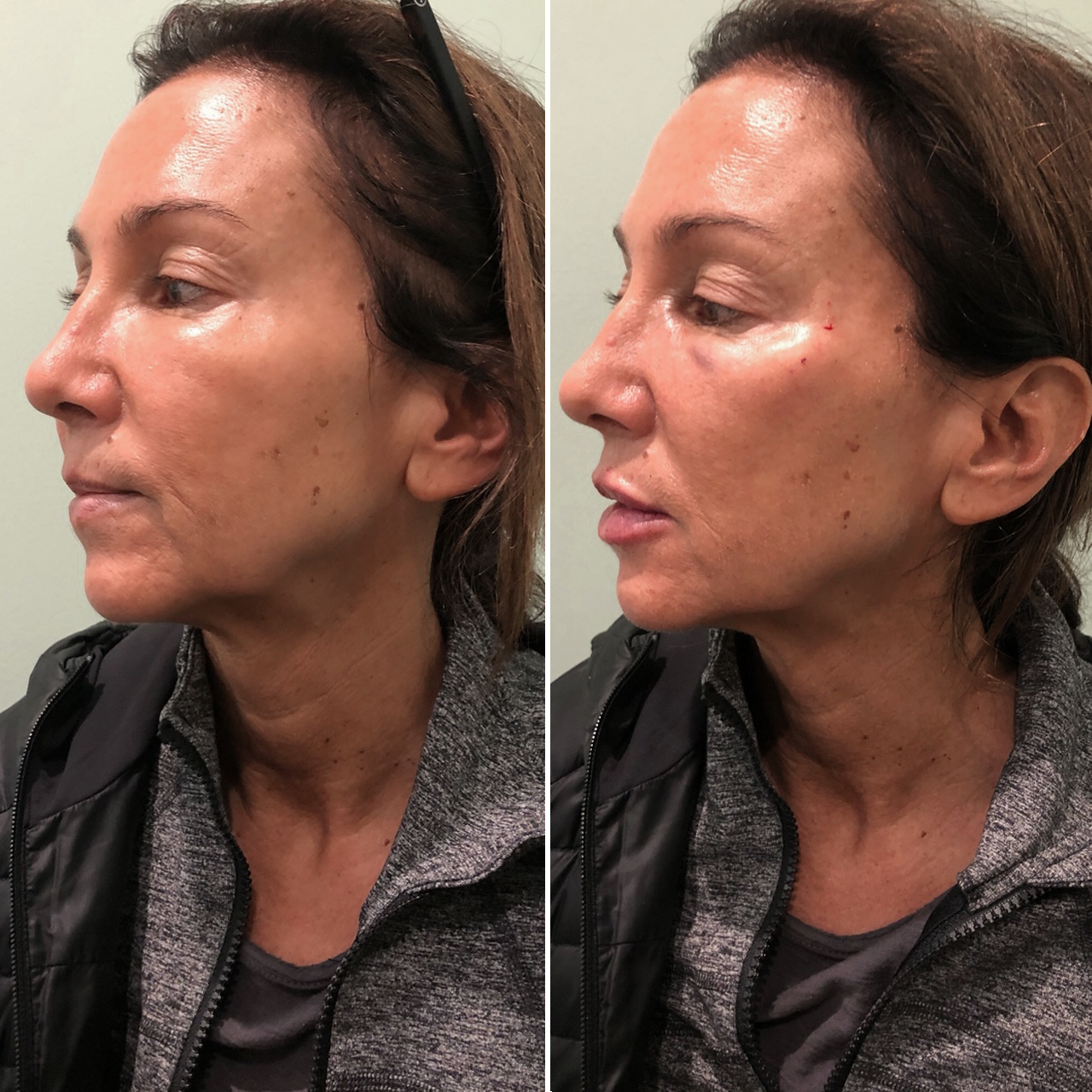 Skin Rejuvenation Results Image 3