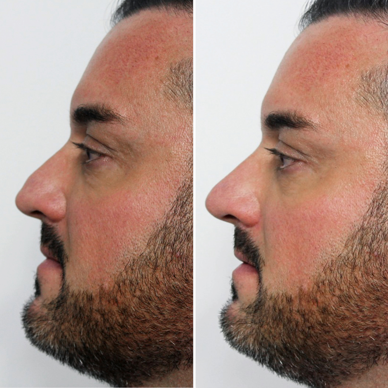 Nose Job Lip Fillers Results Image 3